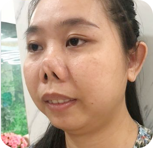 Sửa mũi hỏng